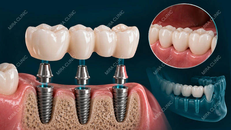 implant-supported bridge